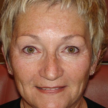 Permanent MakeUp Case 22 - After