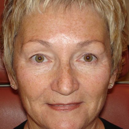 Permanent MakeUp Case 22 - Before