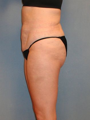 Liposuction: Case 19 - After
