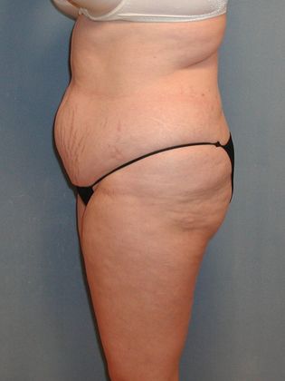 Liposuction: Case 19 - Before
