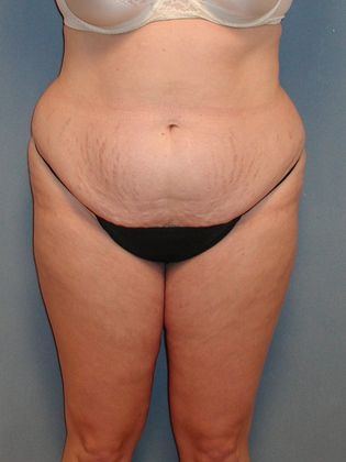 Liposuction: Case 19 - Before