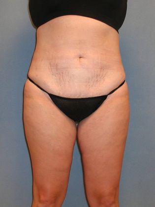 Liposuction: Case 19 - After
