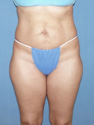 Liposuction: Case 20 - After
