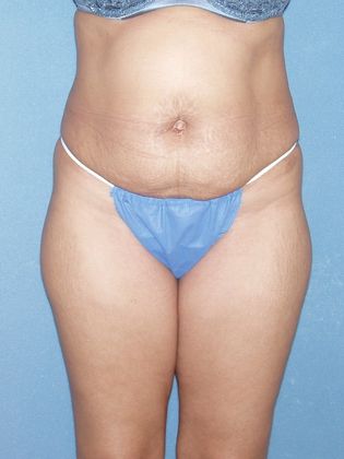 Liposuction: Case 20 - Before