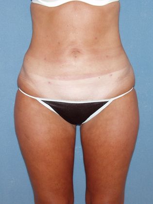Liposuction: Case 21 - After