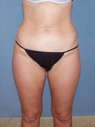 Liposuction: Case 21 - Before