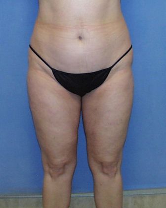 Liposuction: Case 24 - After - Front