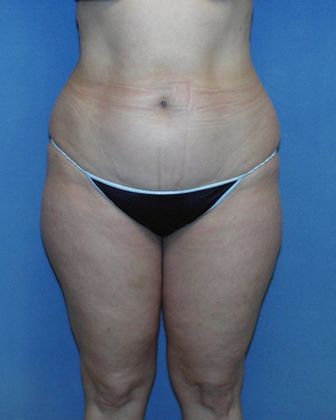 Liposuction: Case 24 - Before - Front