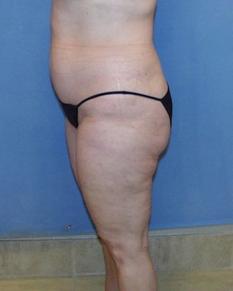 Liposuction: Case 24 - After - Side