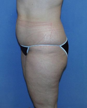 Liposuction: Case 24 - Before - Side