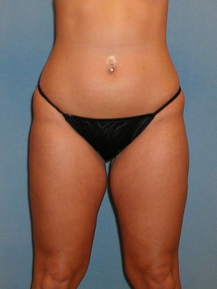 Liposuction: Case 25 - After - Front