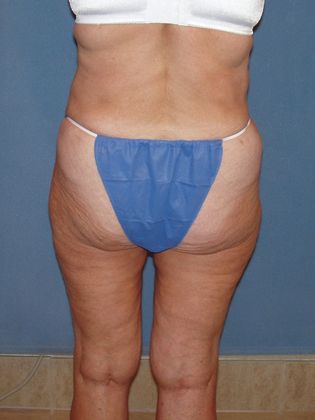 Liposuction: Case 26 - After - back