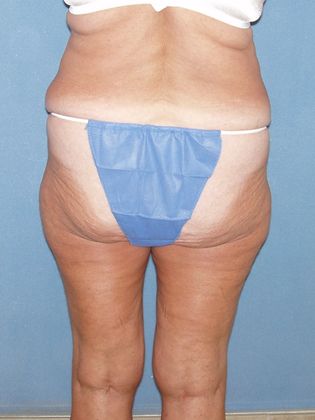 Liposuction: Case 26 - Before - back