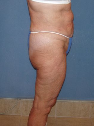 Liposuction: Case 26 - After - Side