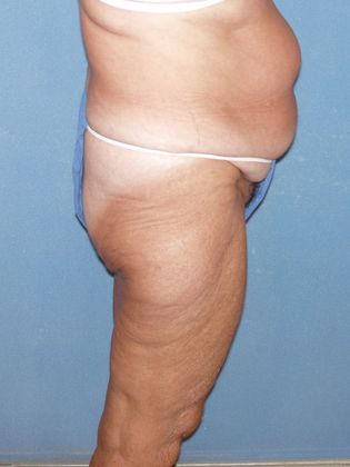 Liposuction: Case 26 - Before - Side