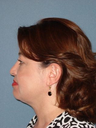 Liposuction: Case 27 - After - Side