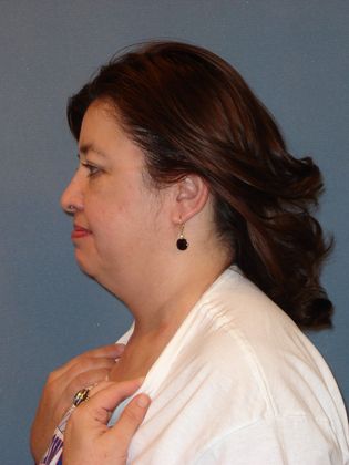 Liposuction: Case 27 - Before - Side