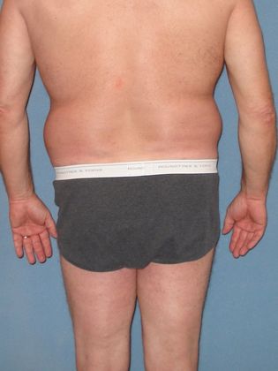 Liposuction: Case 28 - Before - back
