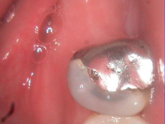 Tooth Colored Fillings Case 1 - Before