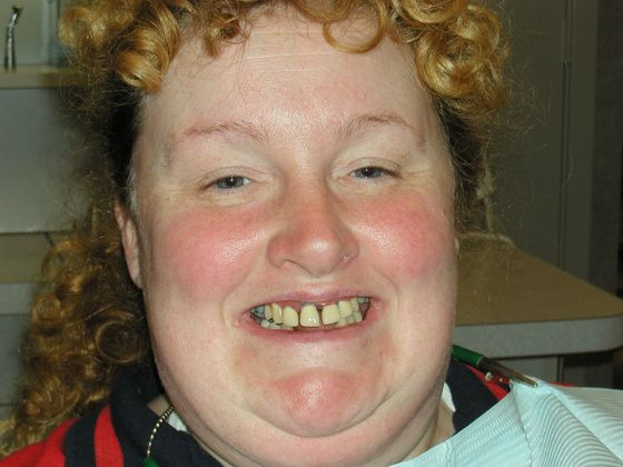 Smile Makeover & Veneers Case 4 - Before