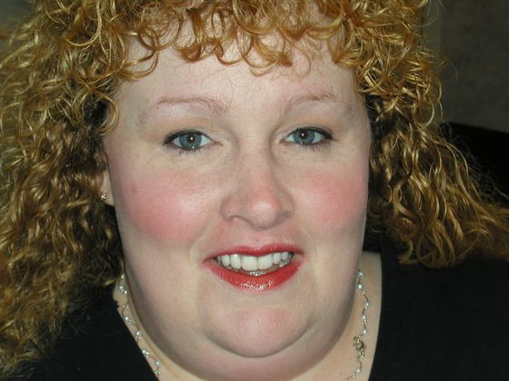 Smile Makeover & Veneers Case 4 - After