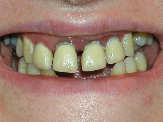 Smile Makeover & Veneers: Case 4 - Before Smile