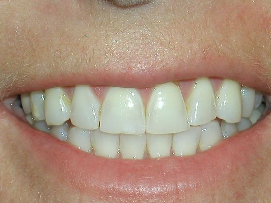 Smile Makeover & Veneers Case 6 - Before
