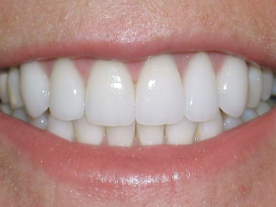 Smile Makeover & Veneers Case 6 - After