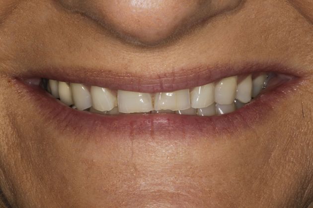 Smile Makeover & Veneers Case 11 - Before