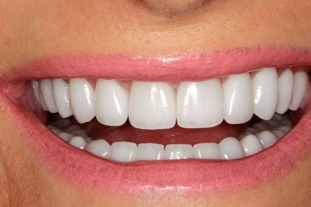 Smile Makeover & Veneers Case 11 - After