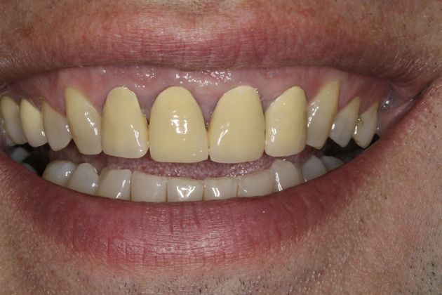 Smile Makeover & Veneers Case 12 - Before