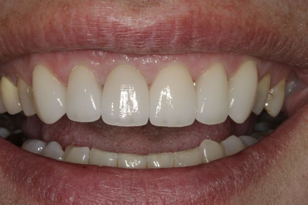Smile Makeover & Veneers Case 12 - After