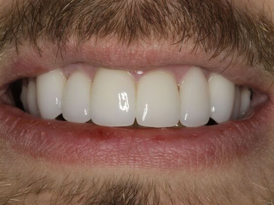 Smile Makeover & Veneers: Case 15 - After Smile