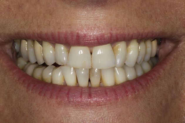 Smile Makeover & Veneers Case 16 - Before