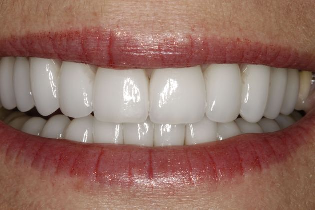 Smile Makeover & Veneers Case 16 - After