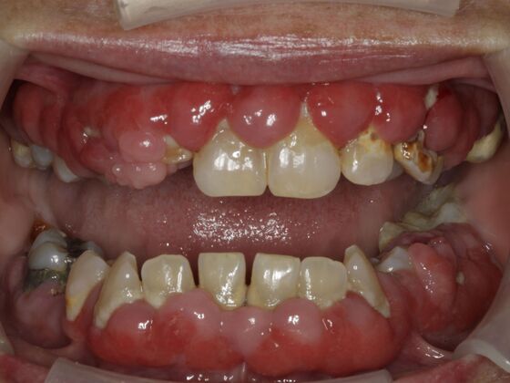 Smile Makeover & Veneers: Case 19 - Before Smile