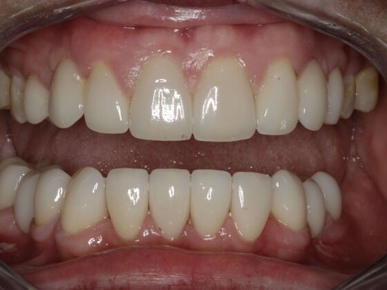 Smile Makeover & Veneers: Case 19 - After Smile