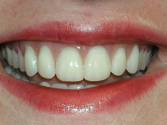 Smile Makeover & Veneers: Case 4 - After Smile