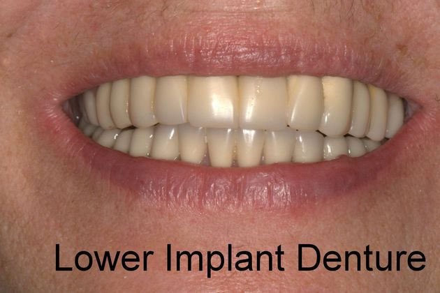 Dental Implants Lower Implant Denture - After