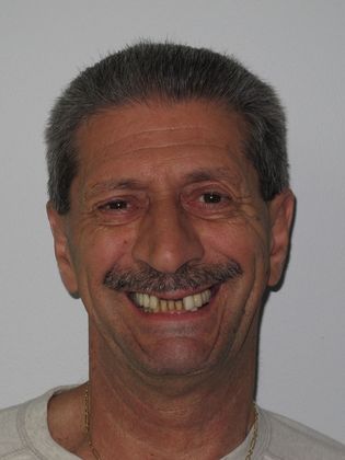 Teeth in a Day: Joe - Before