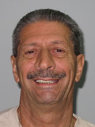 Teeth in a Day: Joe - After