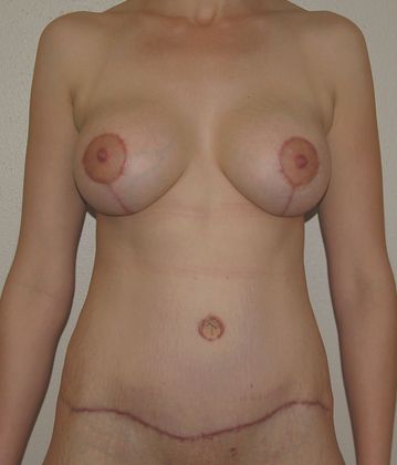 Mommy Makeover Case 23 - After