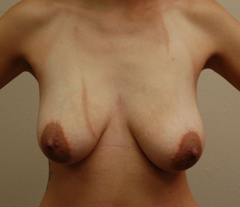 Breast Augmentation w/ Lift: Case 52 - Before