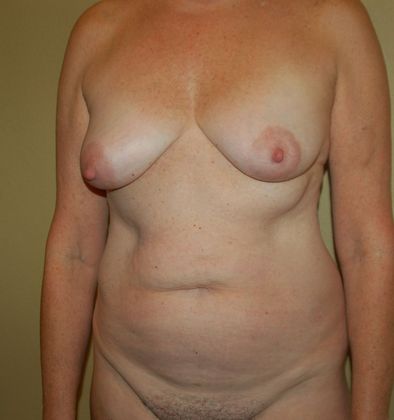 Mommy Makeover: Case 24 - Before