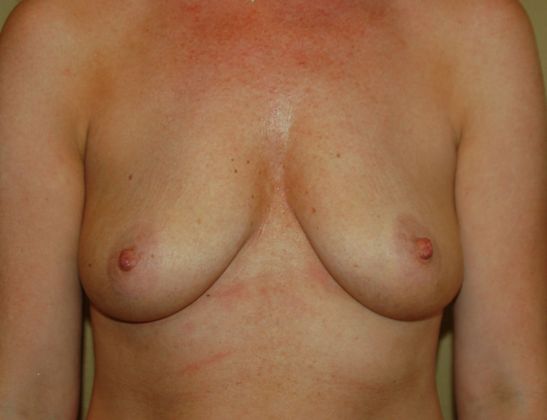 Breast Augmentation Case 763 - Before