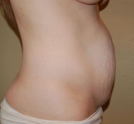 Tummy Tuck (Abdominoplasty): Case 29 - Before