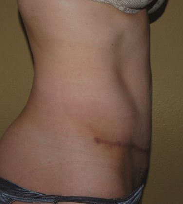 Tummy Tuck (Abdominoplasty): Case 29 - After