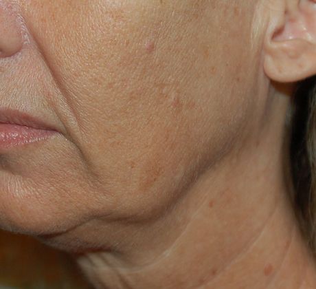 Facelift Case 5 - Before