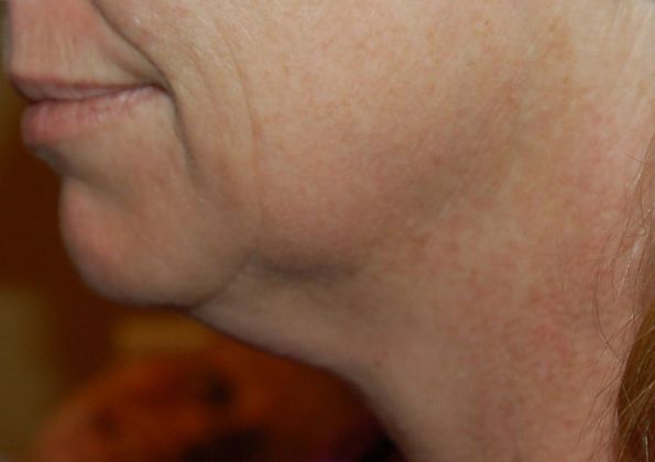 Facelift Case 6 - Before