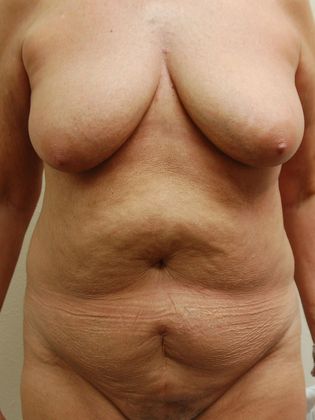 Mommy Makeover Case 25 - Before